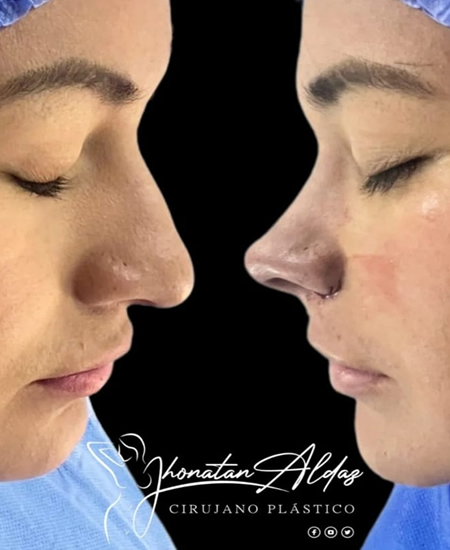 RINOPLASTIA-ULTRASONICA-GUAYAQUIL